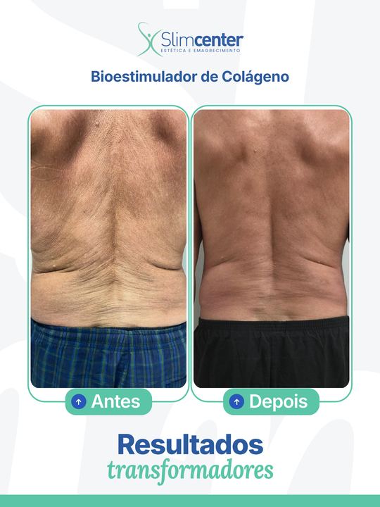Antes e depois de Bioestimulador Corporal