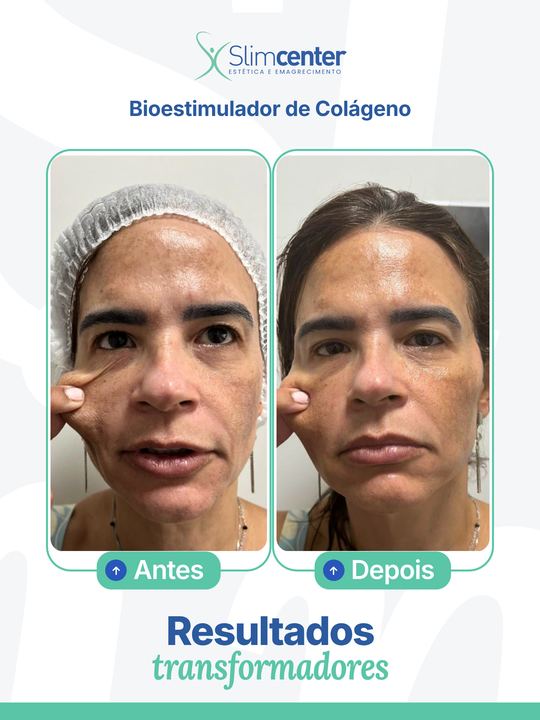 Antes e depois de Bioestimulador Facial