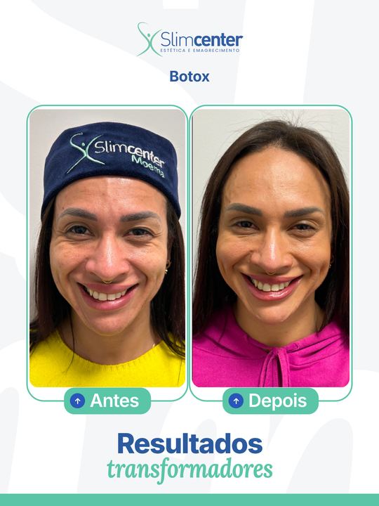 Antes e depois de Toxina Botulínica