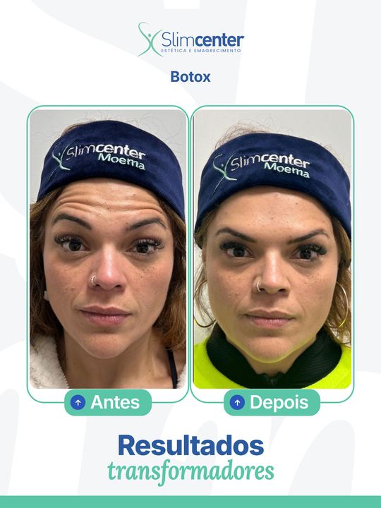 Antes e depois de Toxina Botulínica
