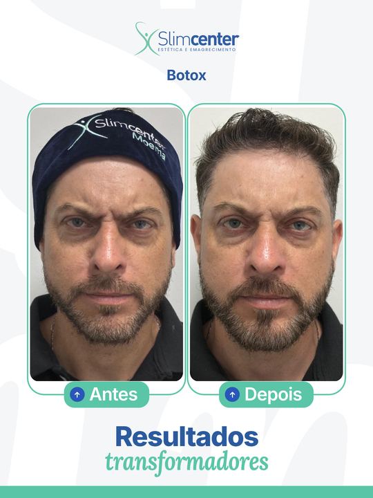 Antes e depois de Toxina Botulínica