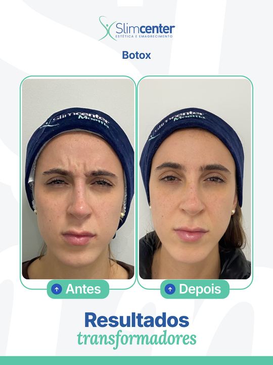Antes e depois de Toxina Botulínica