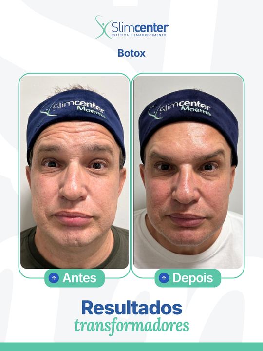 Antes e depois de Toxina Botulínica