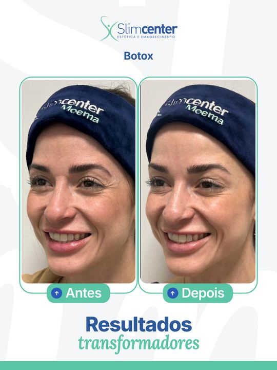 Antes e depois de Toxina Botulínica