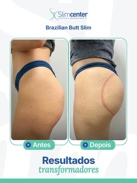 Antes e depois de Brazilian Butt Slim