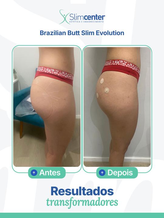 Antes e depois de Brazilian Butt Slim Evolution