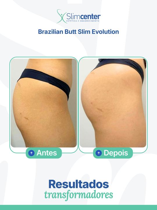 Antes e depois de Brazilian Butt Slim Evolution