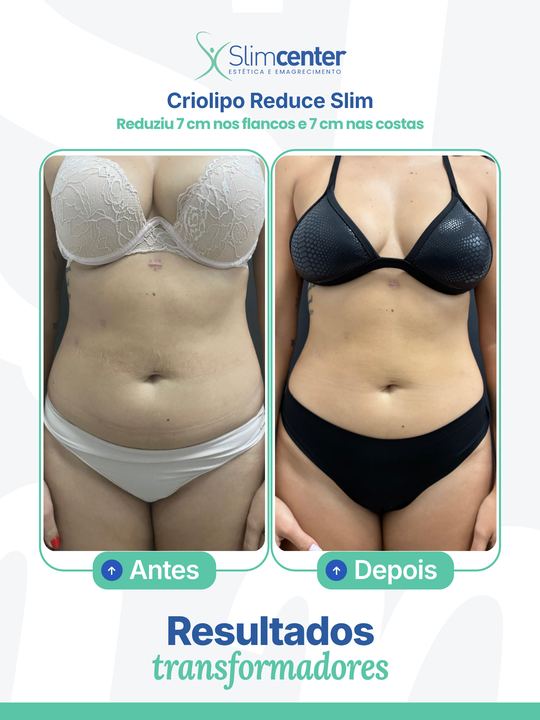 Antes e depois de Criolipo Reduce Slim