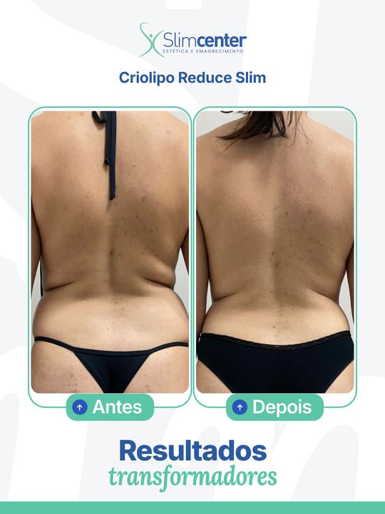 Antes e depois de Criolipo Reduce Slim