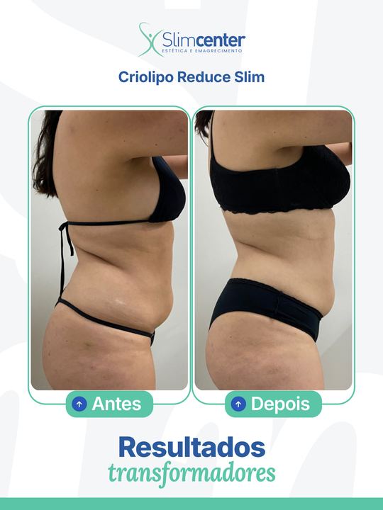 Antes e depois de Criolipo Reduce Slim