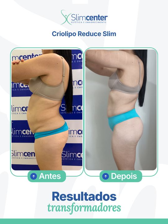 Antes e depois de Criolipo Reduce Slim