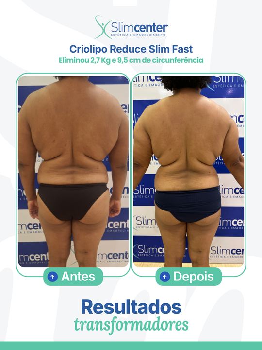 Antes e depois de Criolipo Reduce Slim