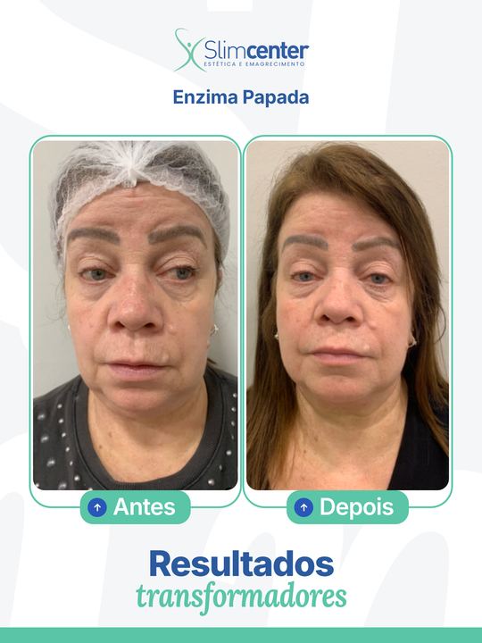 Antes e depois de Papada Slim