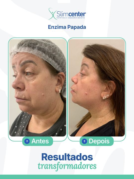 Antes e depois de Papada Slim