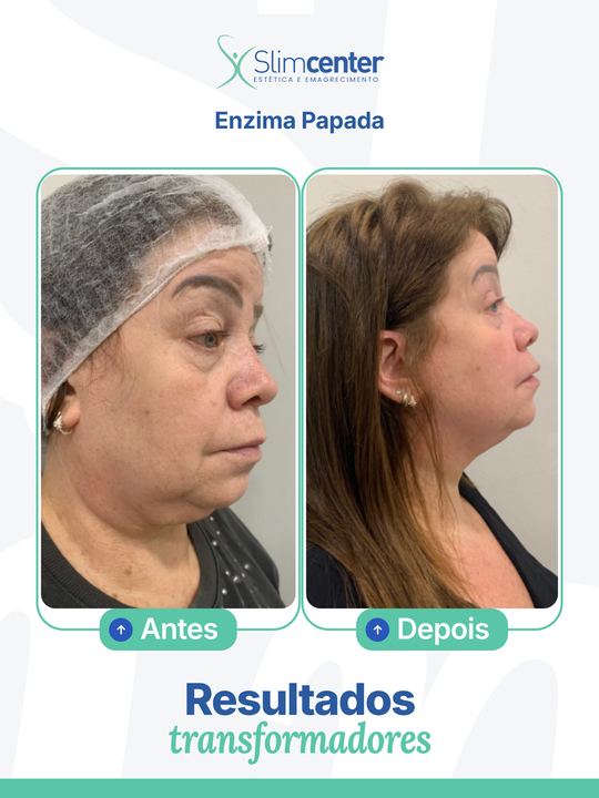 Antes e depois de Papada Slim