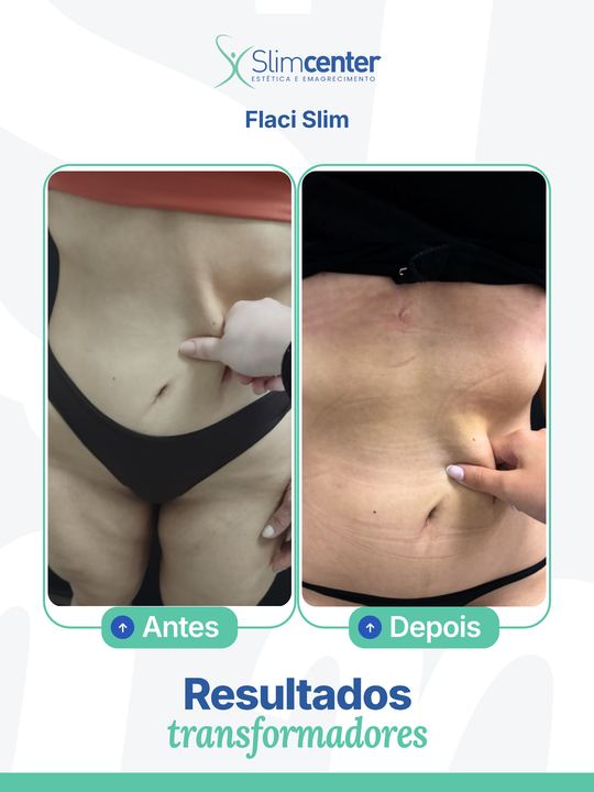 Antes e depois de Flaci Slim