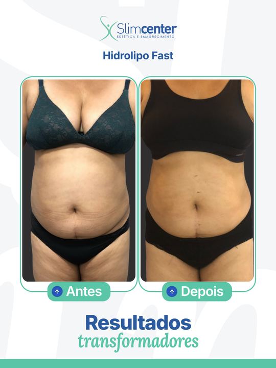 Antes e depois de Hidrolipo Reduce Slim