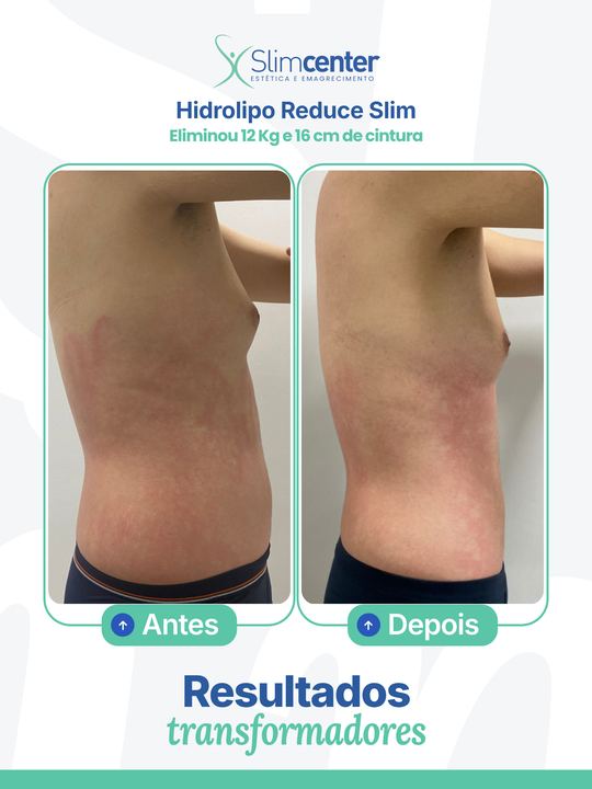 Antes e depois de Hidrolipo Reduce Slim