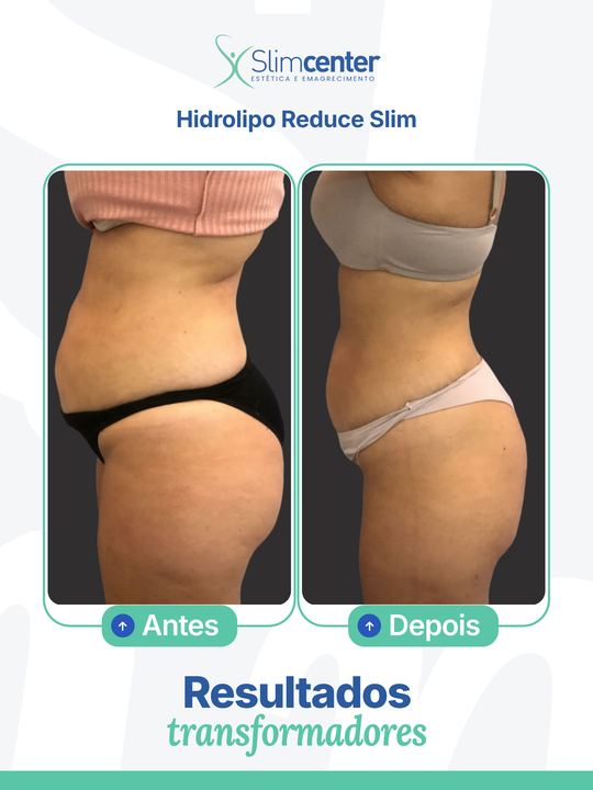 Antes e depois de Hidrolipo Reduce Slim