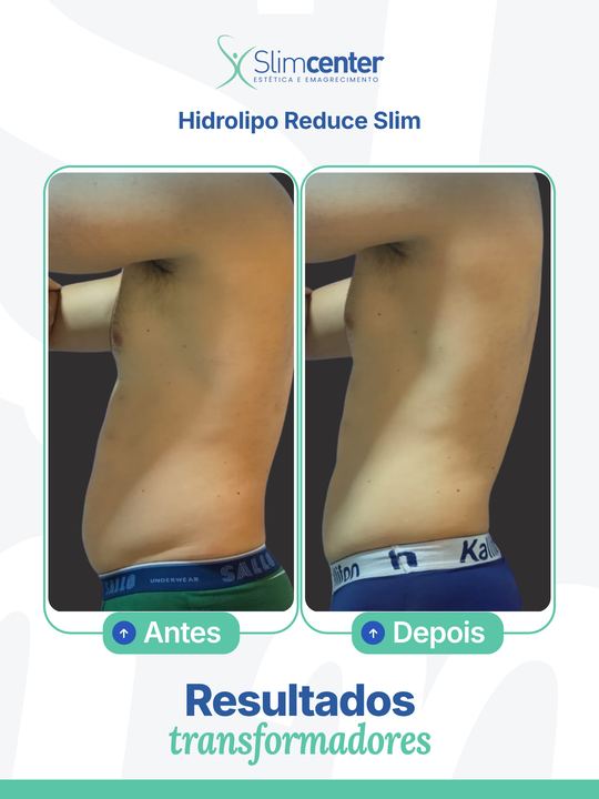 Antes e depois de Hidrolipo Reduce Slim