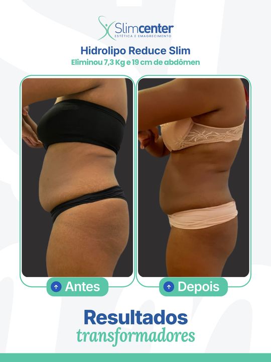Antes e depois de Hidrolipo Reduce Slim