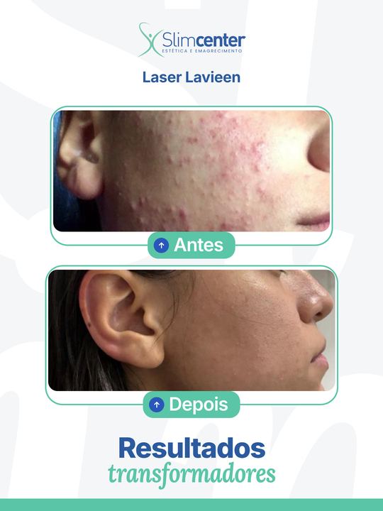 Antes e depois de Lavieen