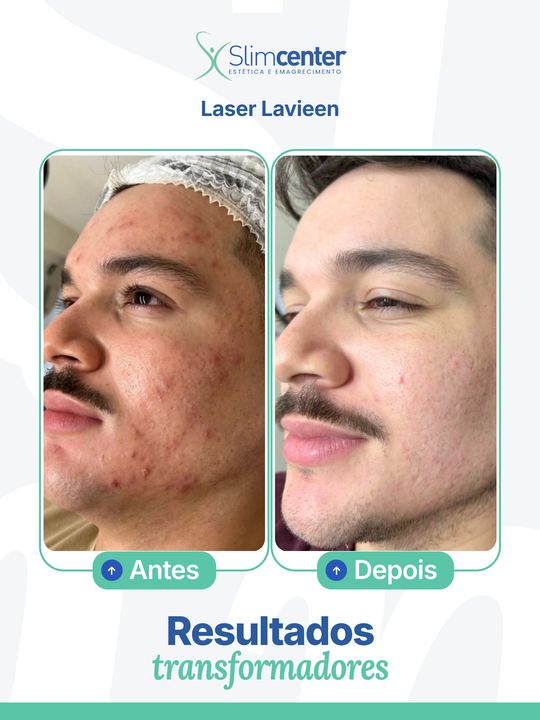 Antes e depois de Lavieen