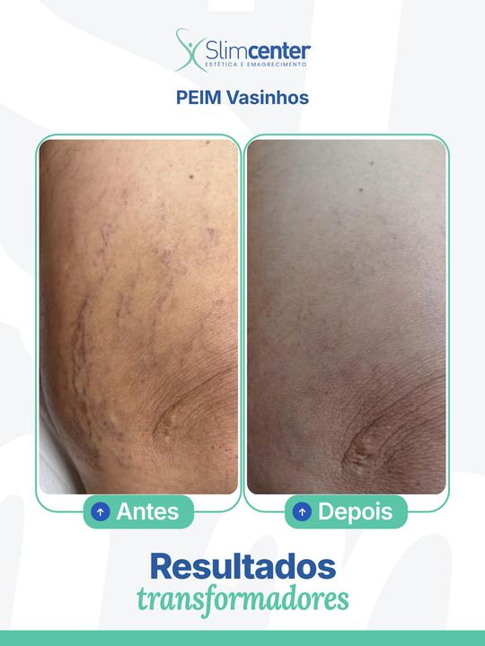 Antes e depois de PEIM, aplicação de vasinhos