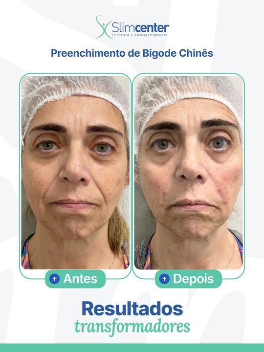 Antes e depois de Preenchimento Facial