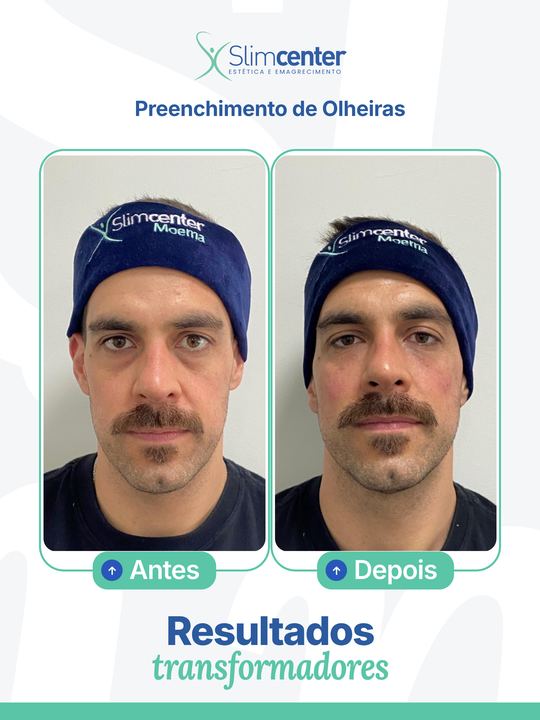 Antes e depois de Preenchimento de Olheiras