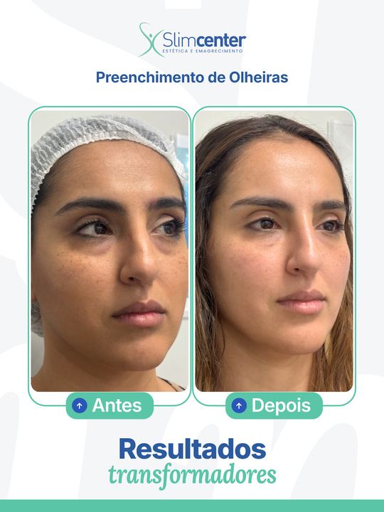 Antes e depois de Preenchimento de Olheiras