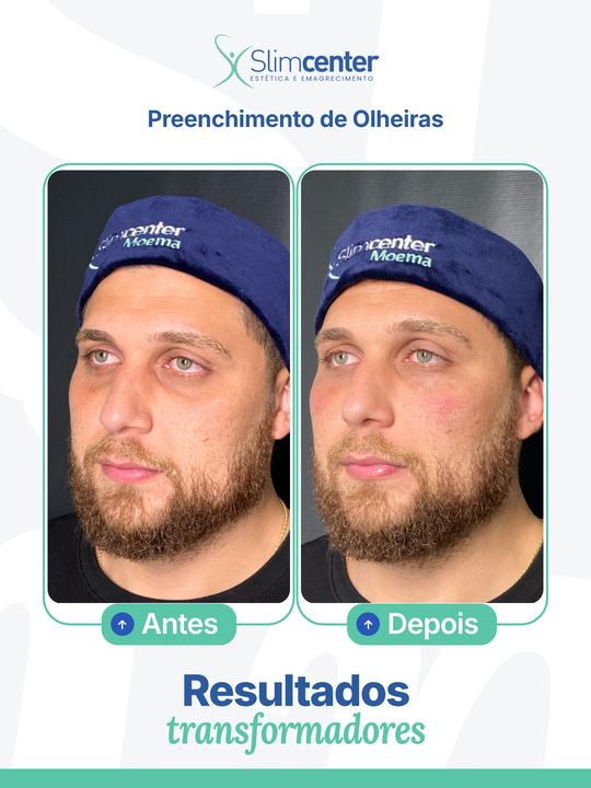 Antes e depois de Preenchimento de Olheiras