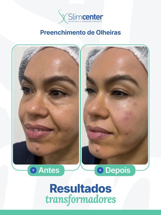 Antes e depois de Preenchimento de Olheiras