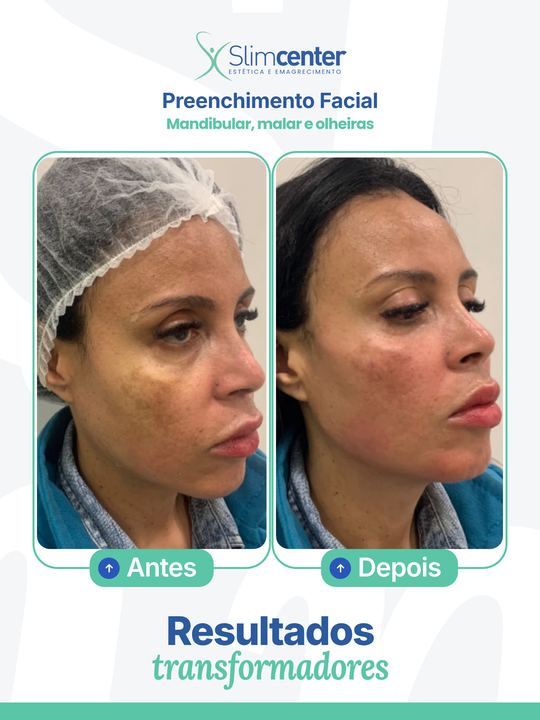 Antes e depois de Preenchimento Facial