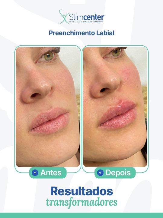 Antes e depois de Preenchimento Labial