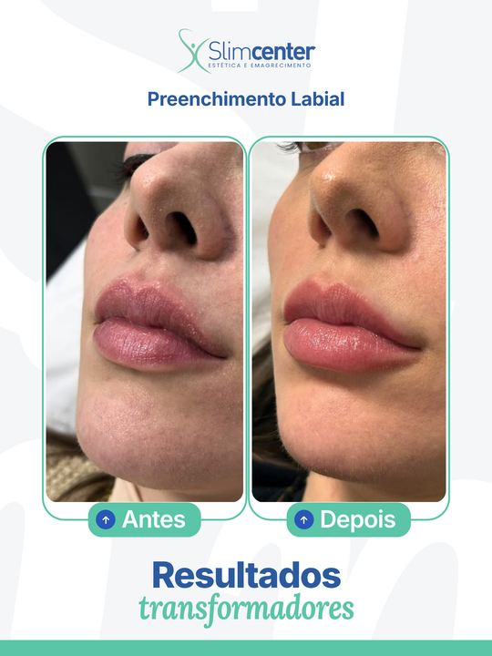 Antes e depois de Preenchimento Labial