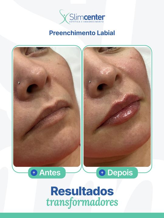 Antes e depois de Preenchimento Labial