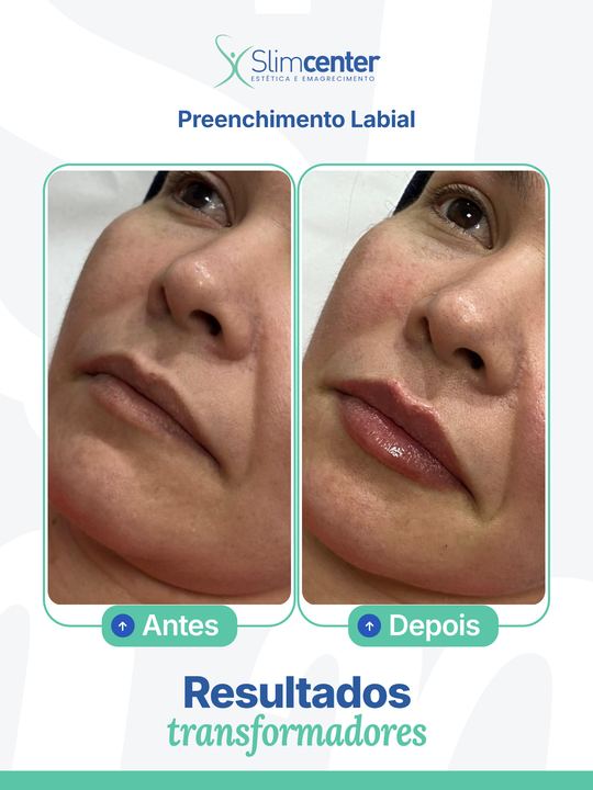 Antes e depois de Preenchimento Labial