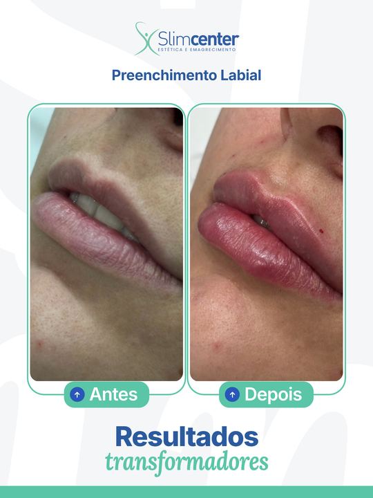 Antes e depois de Preenchimento Labial