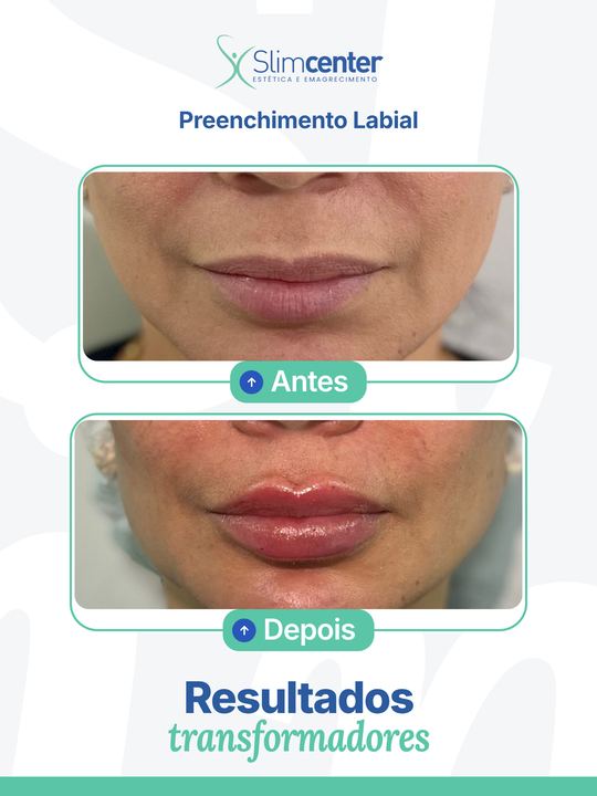 Antes e depois de Preenchimento Labial