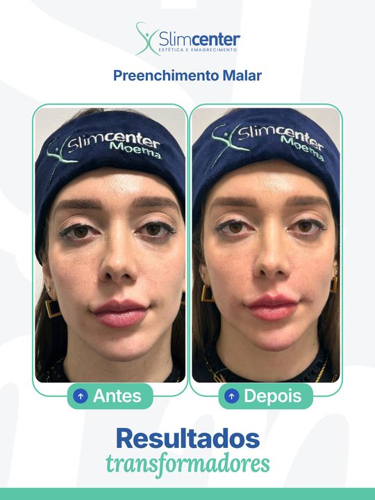 Antes e depois de Preenchimento Facial