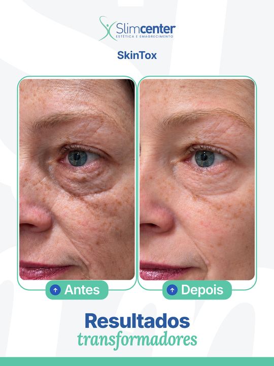 Antes e depois de SkinTox Slim®