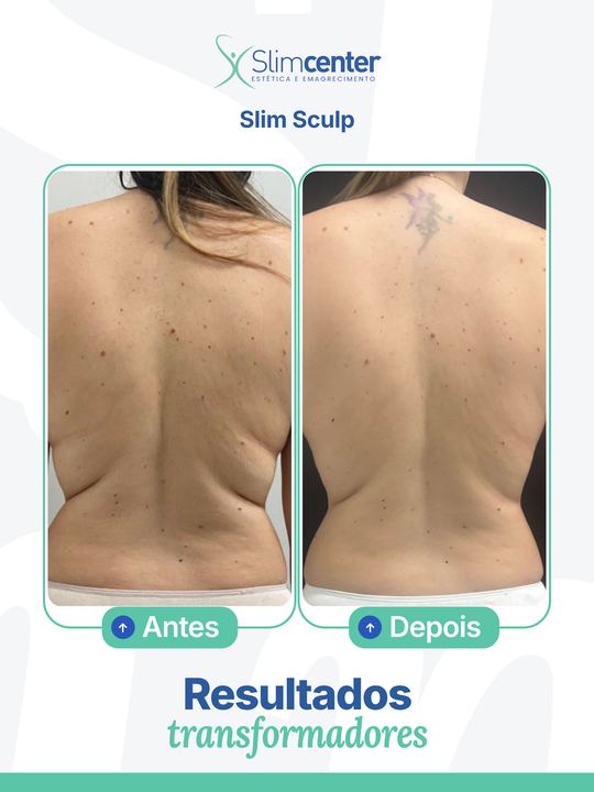 Antes e depois de Slim Sculp