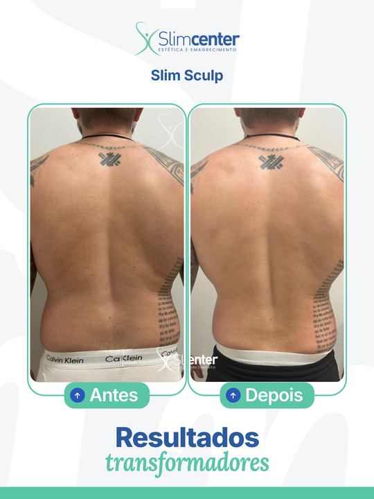 Antes e depois de Slim Sculp