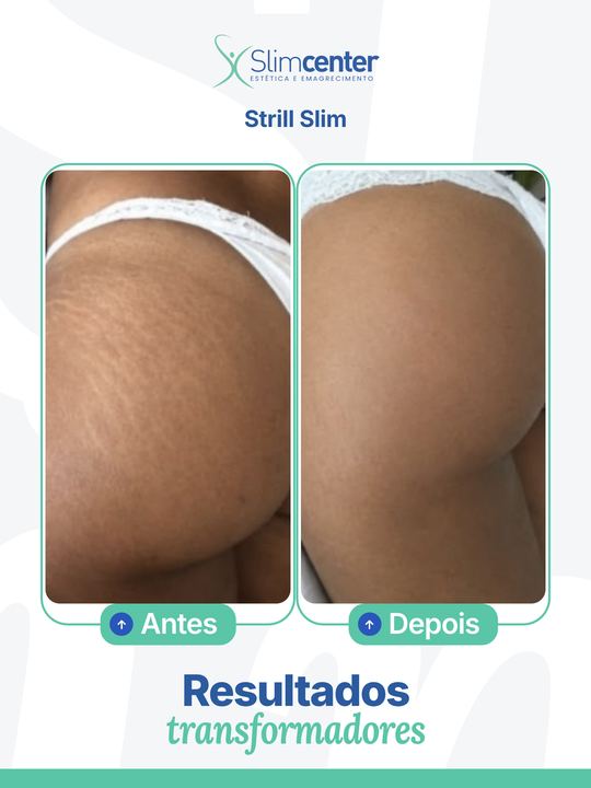 Antes e depois de Strill Slim