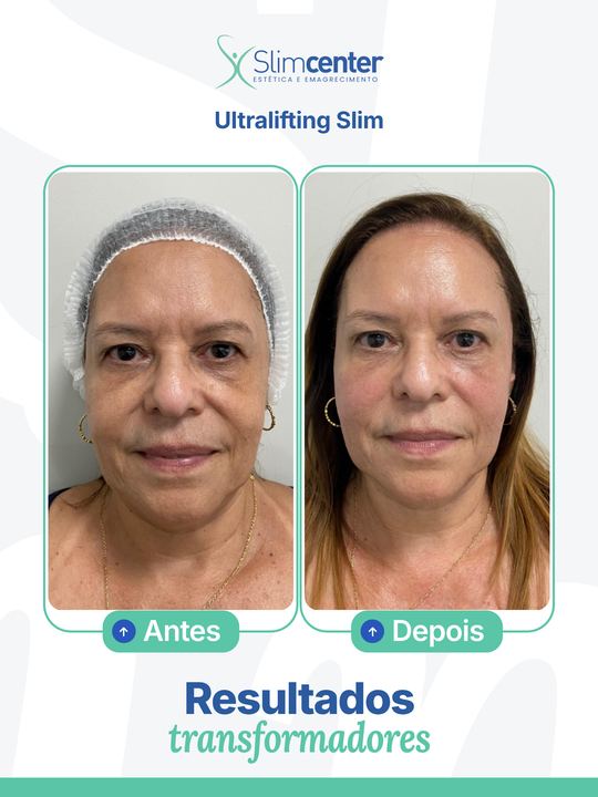Antes e depois de Ultralifting Slim