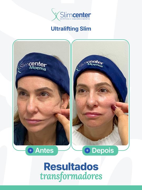 Antes e depois de Ultralifting Slim