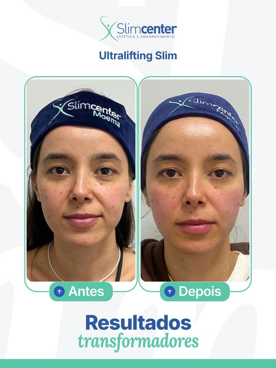 Antes e depois de Ultralifting Slim