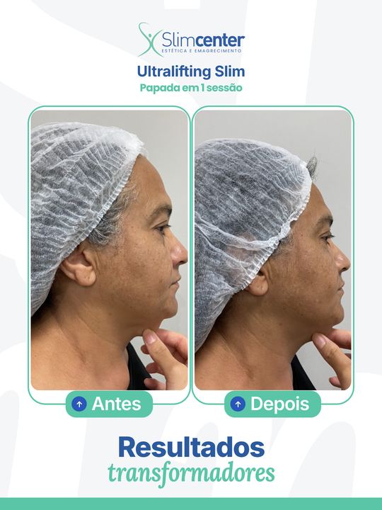 Antes e depois de Ultralifting Slim