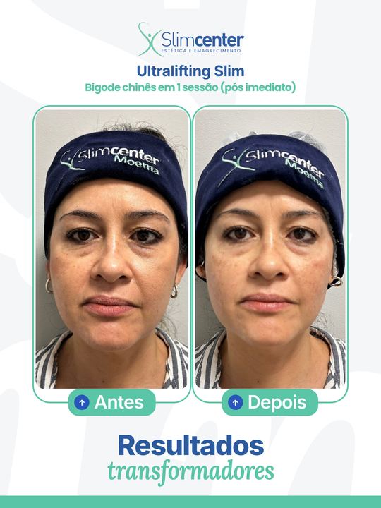 Antes e depois de Ultralifting Slim
